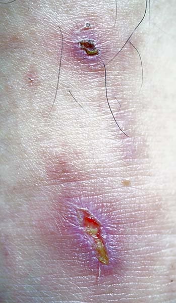 image of a bed sore