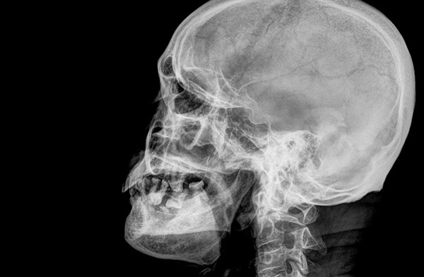 skull xray of brain injury